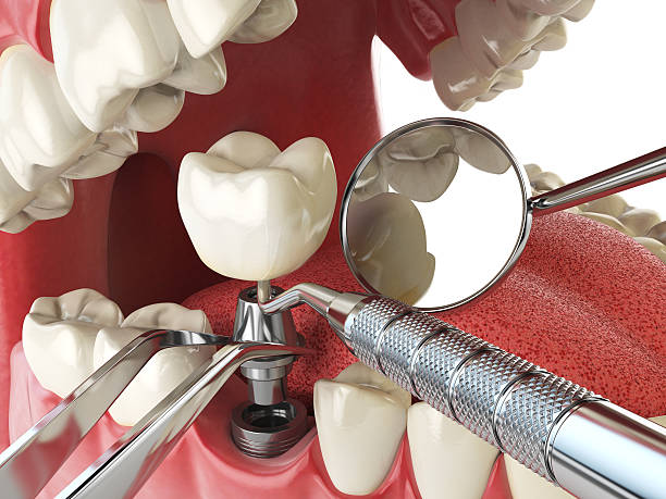 Emergency Dental Filling Replacement in SC